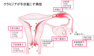 クラミジア　不妊　子宮外妊娠　検査　アイラボ
