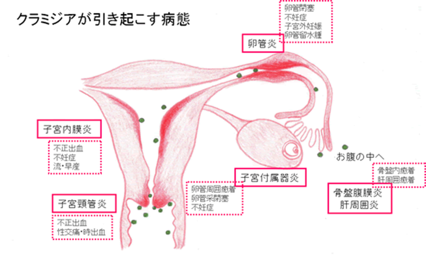 クラミジアによる女性の合併症
