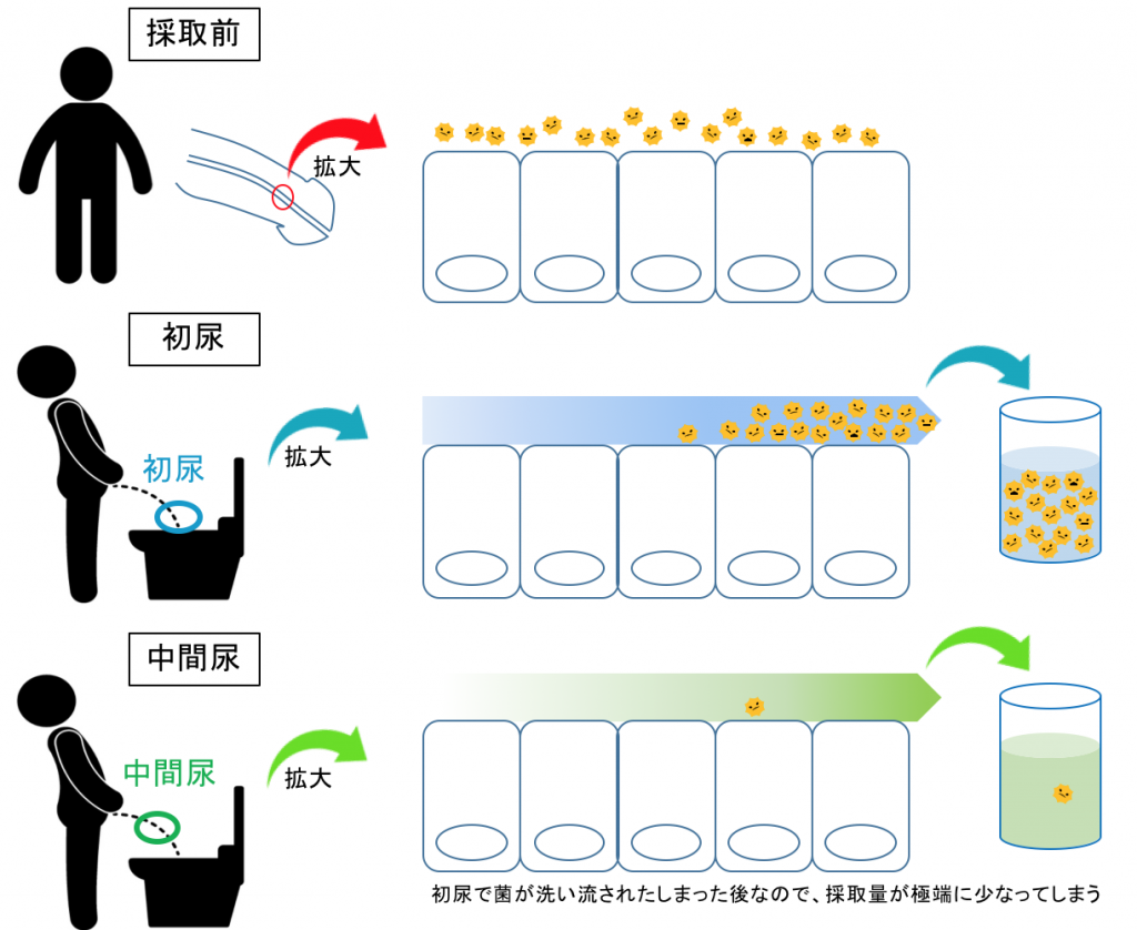 淋病 初尿