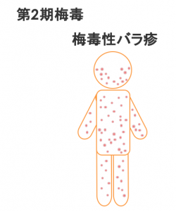 第二期梅毒 梅毒性バラ疹