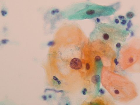子宮頸がん検査の結果　ASC-US　アスカス