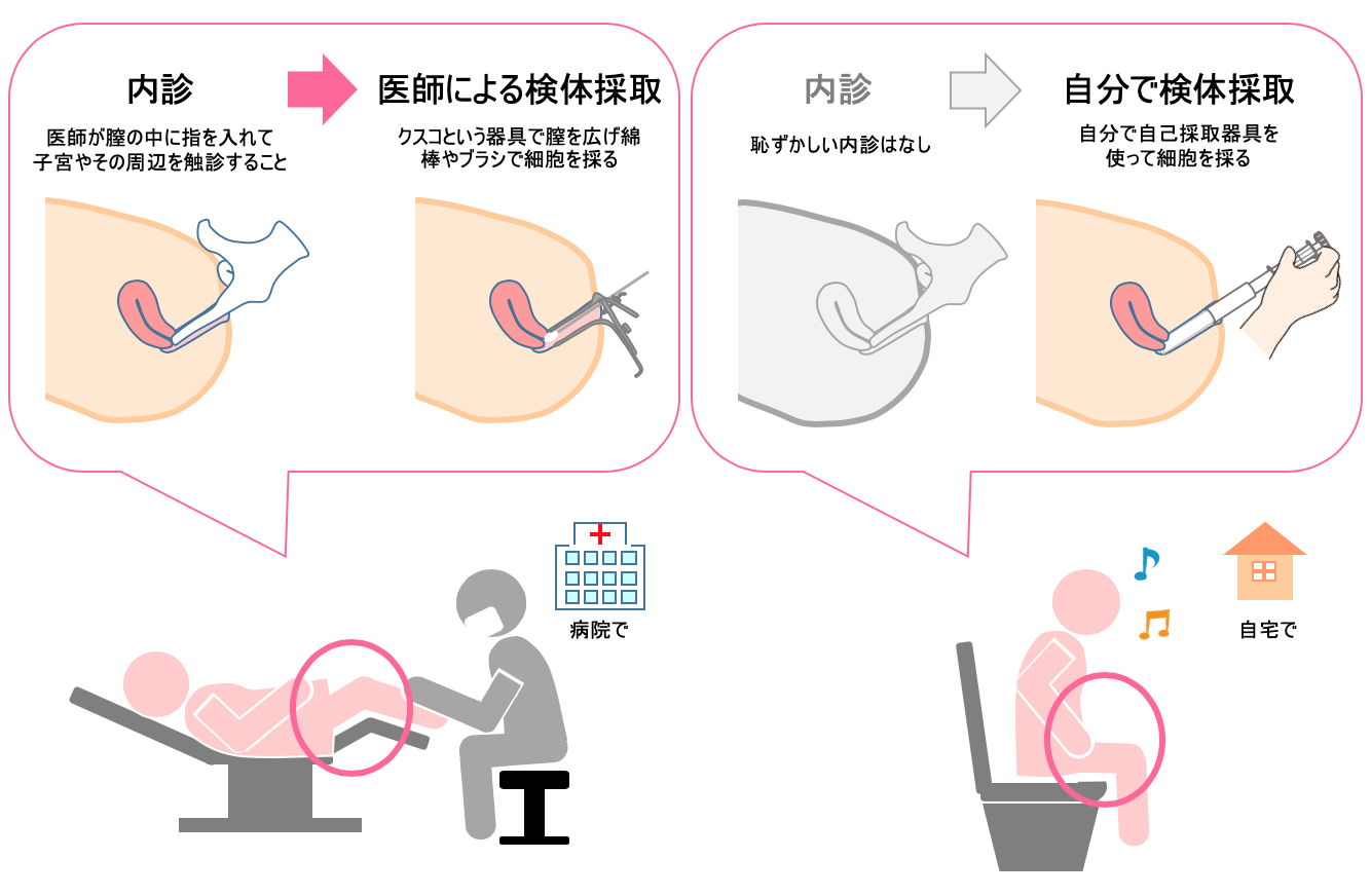 病院で医師による検査と、自己採取での検査の違いの比較