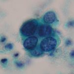 子宮頸がん検査の結果　HSIL