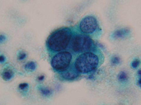 子宮頸がん検査の結果　HSIL