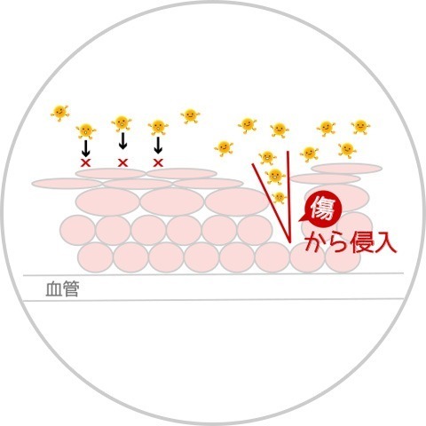 子宮頸がんとは